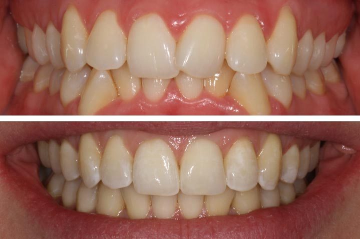 Tandställning före och efter